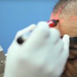 find hair transplant clinic